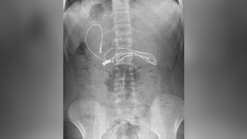 OMG!  Terrible pain was happening in the child's stomach, doctors were shocked after doing X-ray!