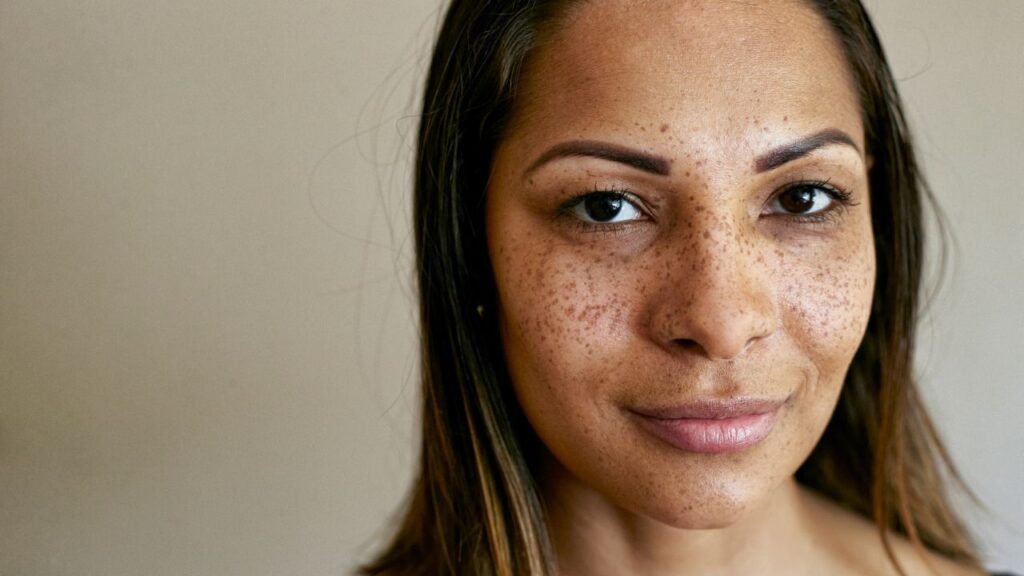 Effective Spice Remedy for Pimples: How to Apply on Your Face