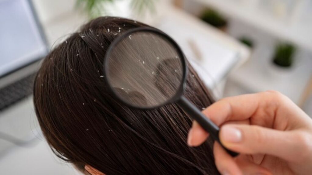 How Oil Increases Dandruff: Tips on What to Do and Avoid